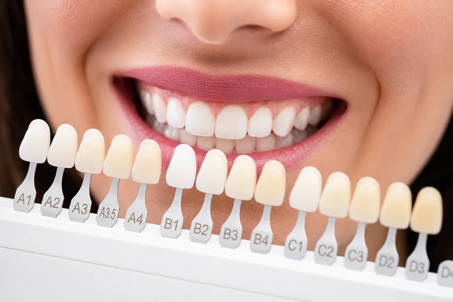 Escala de cores de dentes posicionada diante do sorriso da paciente