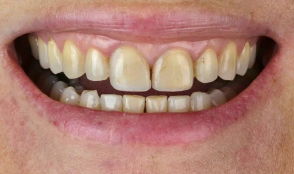 Antes: Lentes de contato dental