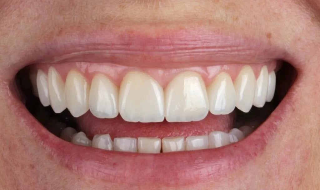 Depois: Lentes de contato dental