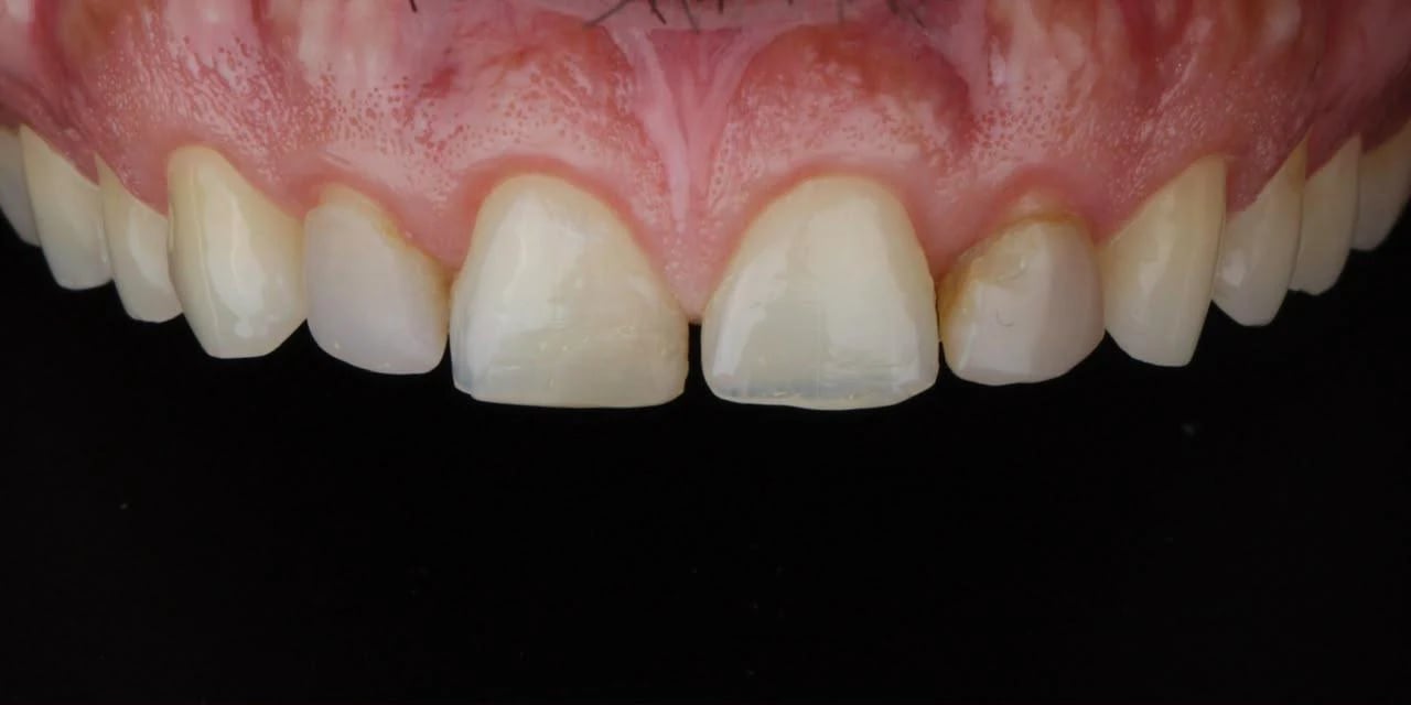 Antes: Lentes de contato dental