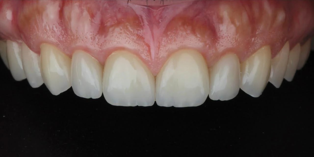 Depois: Lentes de contato dental